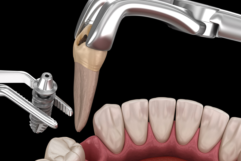 外科手術（インプラント体の埋入）