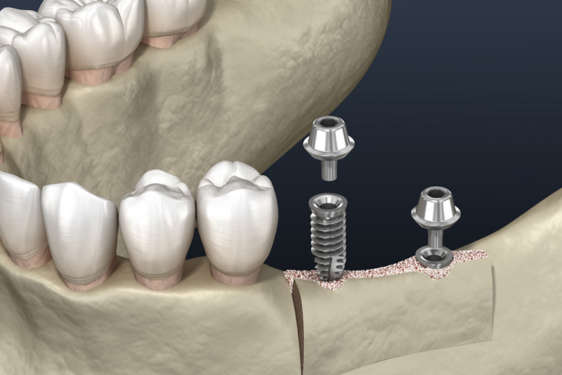 土台（アバットメント）の装着