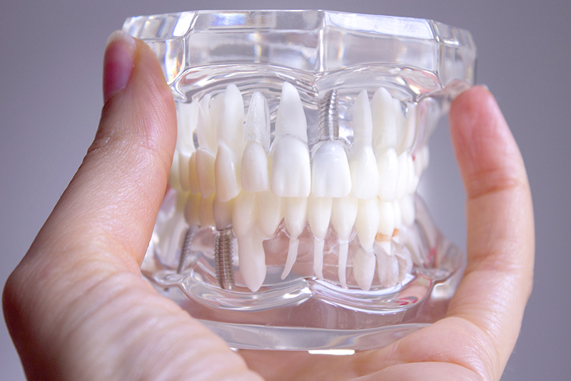 インプラント周囲炎