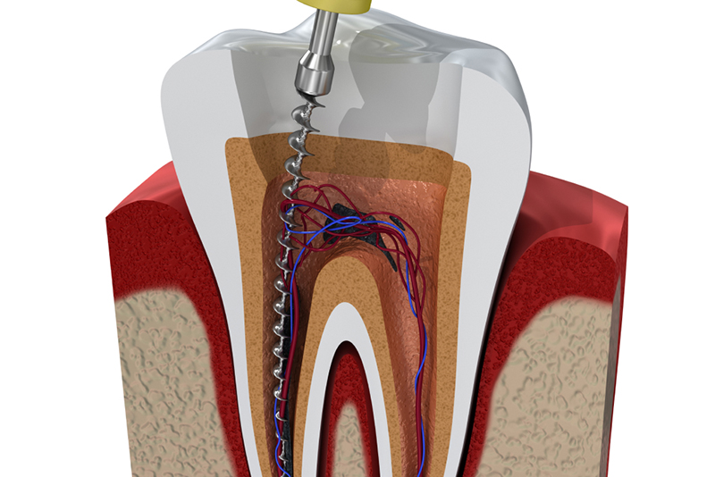 感染した神経の除去