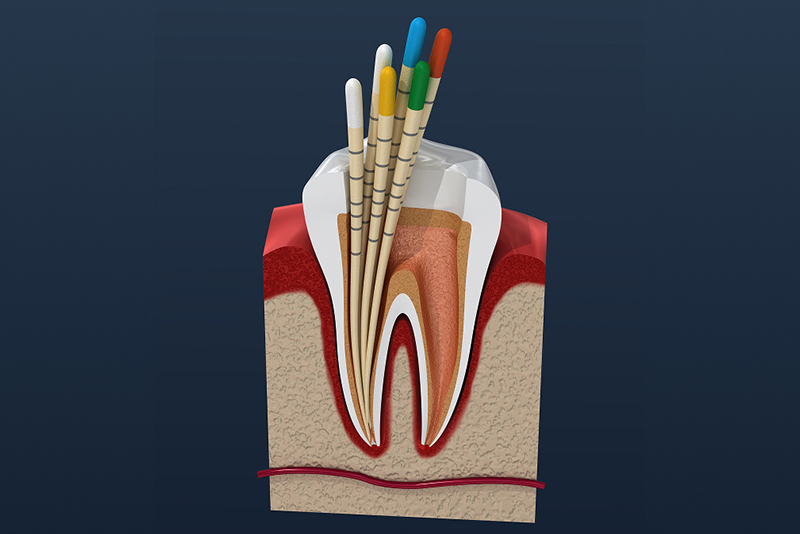 根管内部の清掃