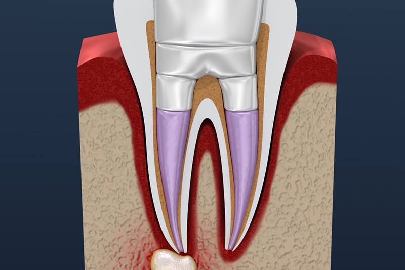 薬剤を充填する