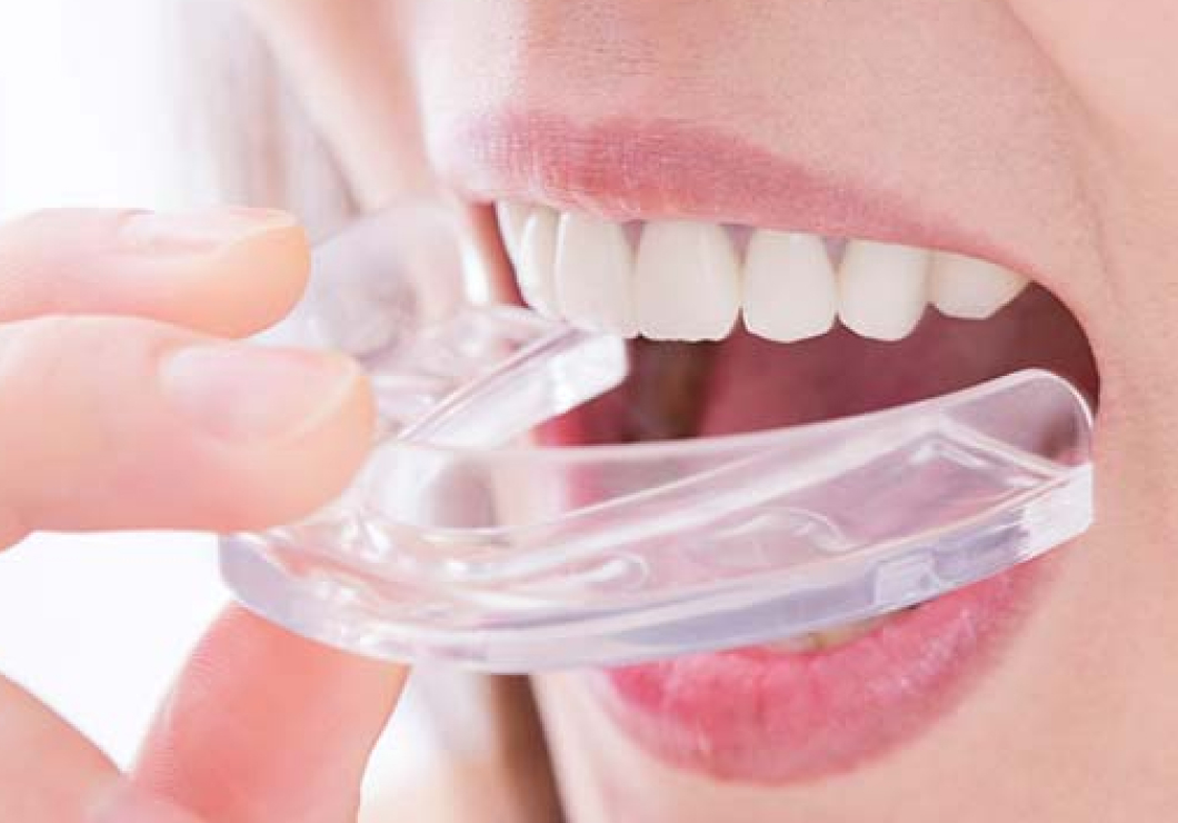 各種マウスピース製作