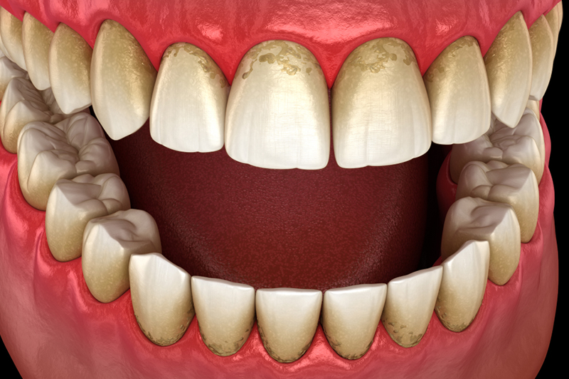 歯周病の原因とは？