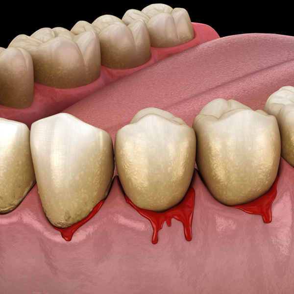歯周病と全身疾患との関係