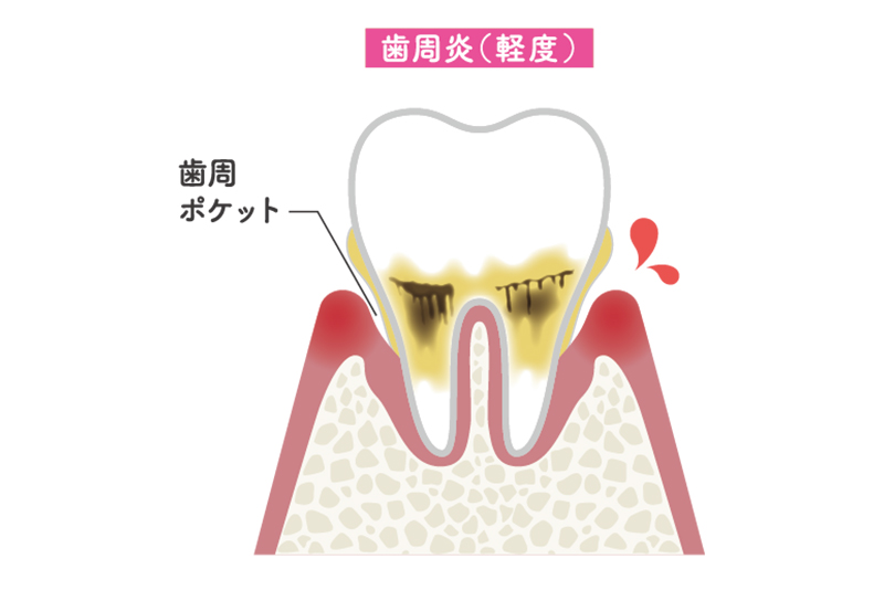 軽度歯周炎
