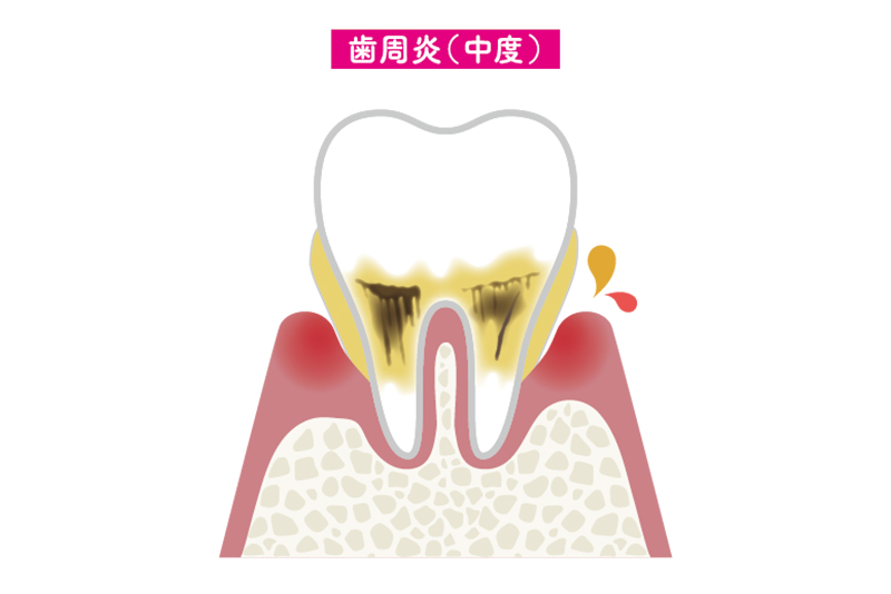 中度歯周炎