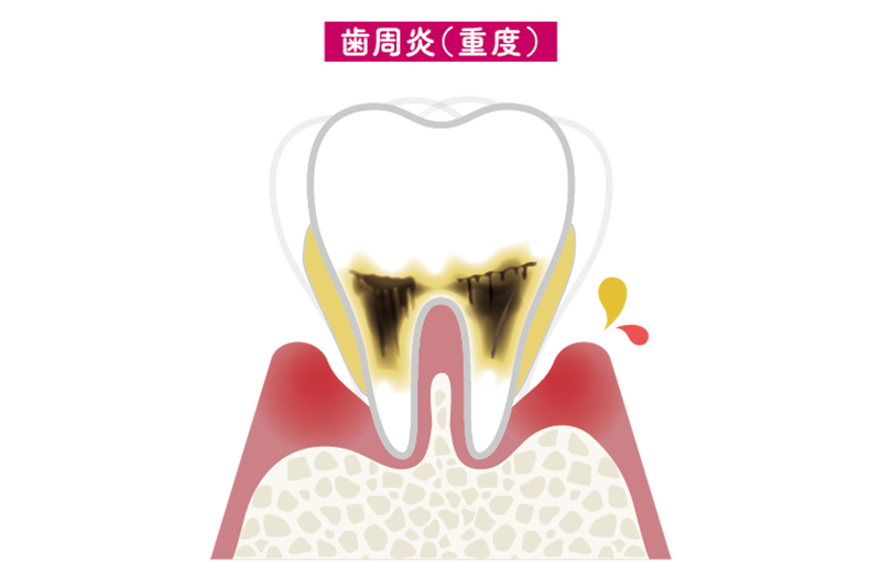重度歯周炎