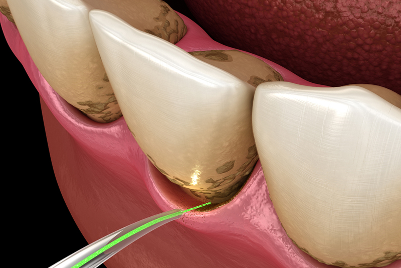 進行した歯周病の治療
