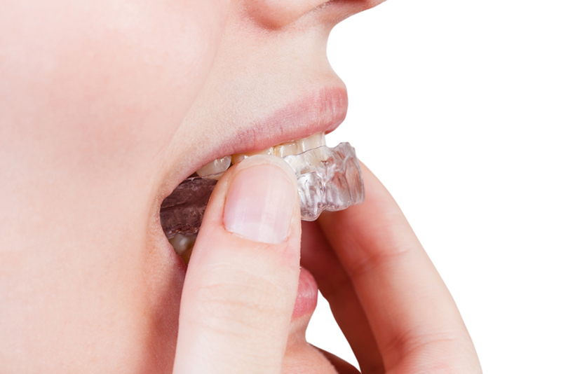 ホームホワイトニング