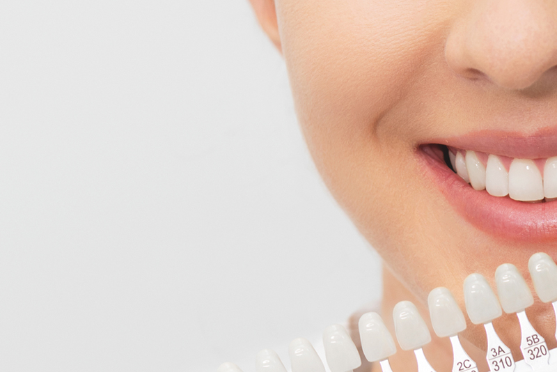 歯の色の確認とホワイトニングの説明